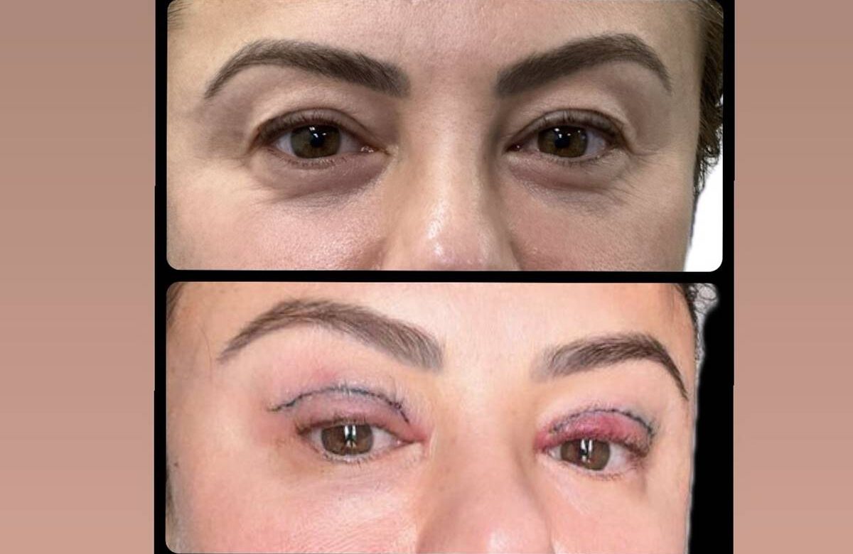 montagem com fotos de olhos antes e depois de cirurgia - metrópoles