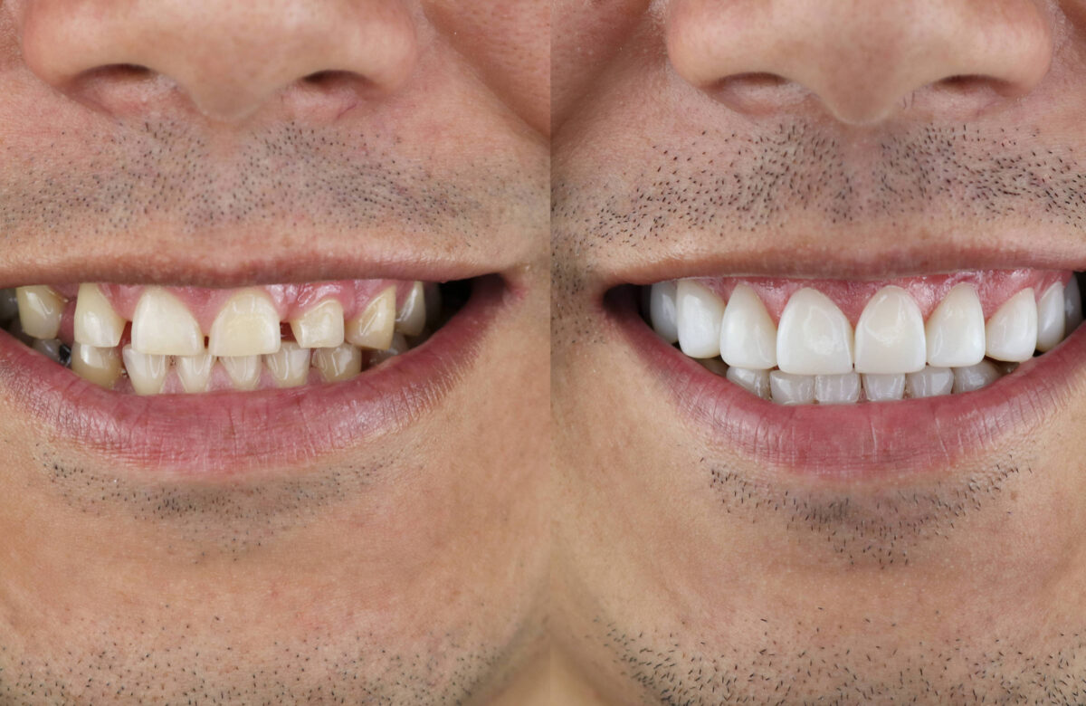 A imagem mostra a comparação de dois sorrisos de uma mesma pessoa. À esquerda, os dentes estão amarelados e apresentam manchas, enquanto à direita, os dentes estão brancos e bem cuidados, evidenciando uma diferença significativa na estética dental.