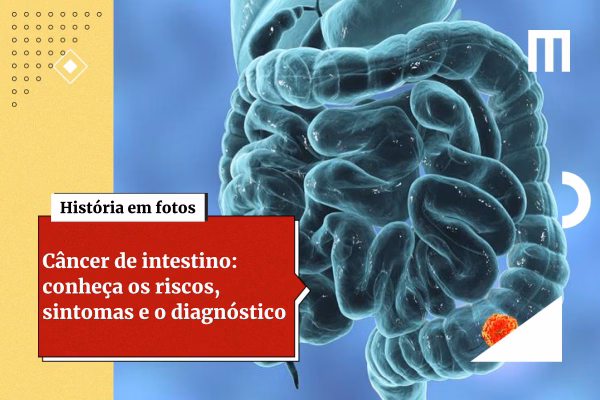 Câncer de intestino: saiba como é feita e quando começar a prevenção