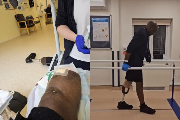 Homem queima os pés em casa e acaba tendo que amputar a perna. Entenda