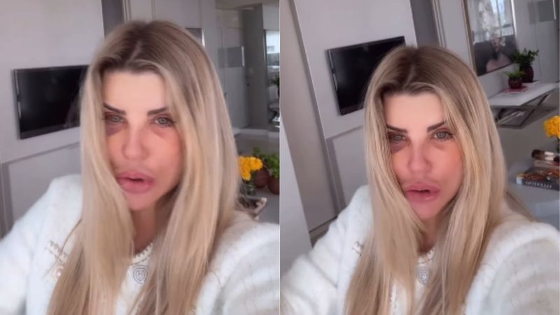 Íris Stefanelli mostra rosto 28 dias após procedimentos estéticos; confira