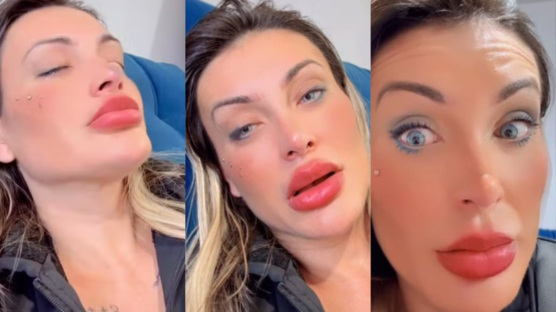 Médico analisa recuperação após alteração da cor dos olhos de Andressa Urach: ‘Complicações’