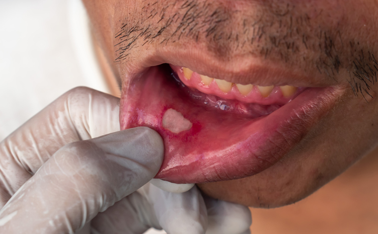 Saiba como tratar aftas de forma caseira e quando procurar o dentista