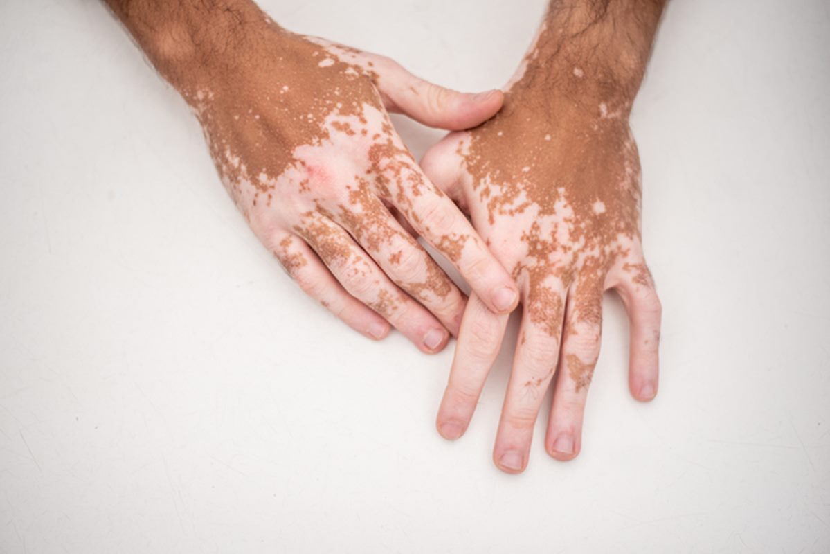 Vitiligo: entenda causas, sintomas e tratamento
